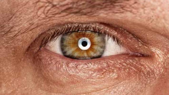 Göz Melanomunun Nedenleri Nelerdir?