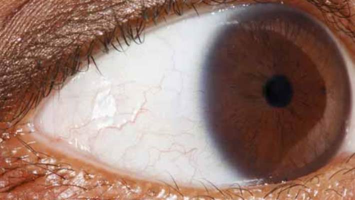 Goz Melanomun Tedavi Yontemleri Nelerdir Saglik Haberleri