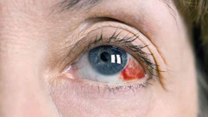 Göz Melanomunun Neden Olduğu Sağlık Sorunları Nelerdir?