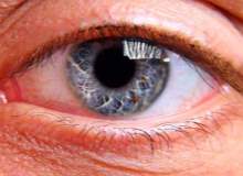 Göz melanomun teşhisi nasıldır?