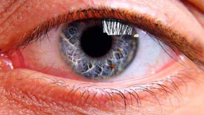 Göz Melanomun Teşhisi Nasıldır?