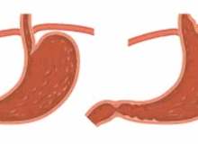 Gastrit Riskini Arttıran Faktörler Nelerdir? Gastrit Riskini Arttıran Faktörler Nelerdir?