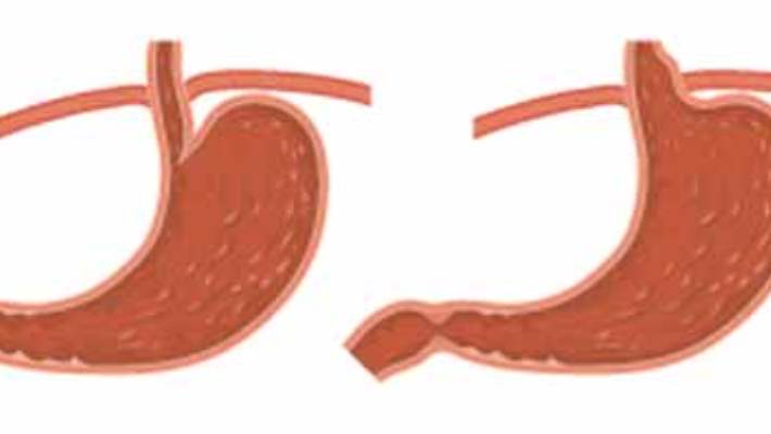 Gastrit Riskini Arttıran Faktörler Nelerdir?