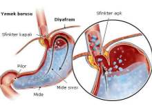 Gastritin neden olduğu sağlık sorunları nelerdir? Gastritin neden olduğu sağlık sorunları nelerdir?