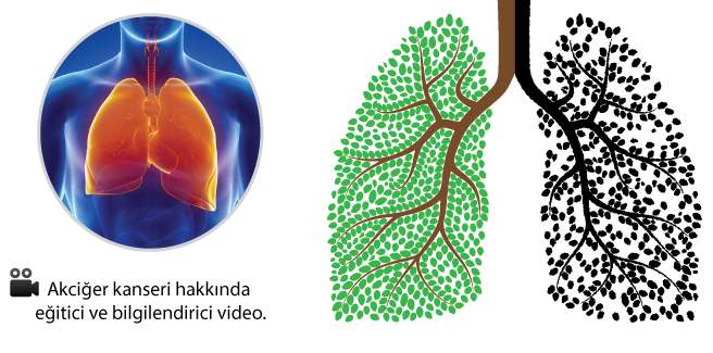 İnflamatuar göğüs kanseri nasıl teşhis edilir?