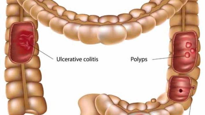 Hassas Bağırsak Sendromunda Nelere Dikkat Edilimelidir?