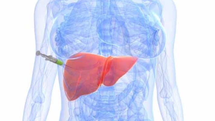 Karaciğer Kanserinin Türleri Nelerdir?