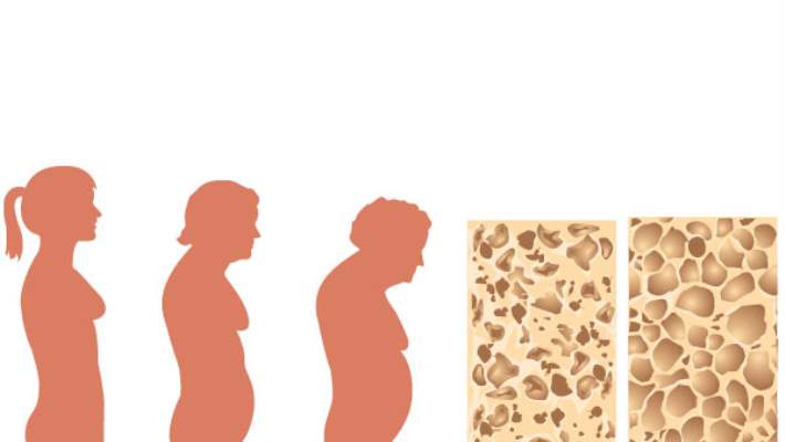 Osteoporozu Önlemenin Yolları