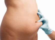 Liposuction, Kadınlar için Vaser Hi Def