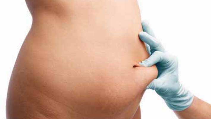 Liposuction, Kadınlar İçin Vaser Hi Def