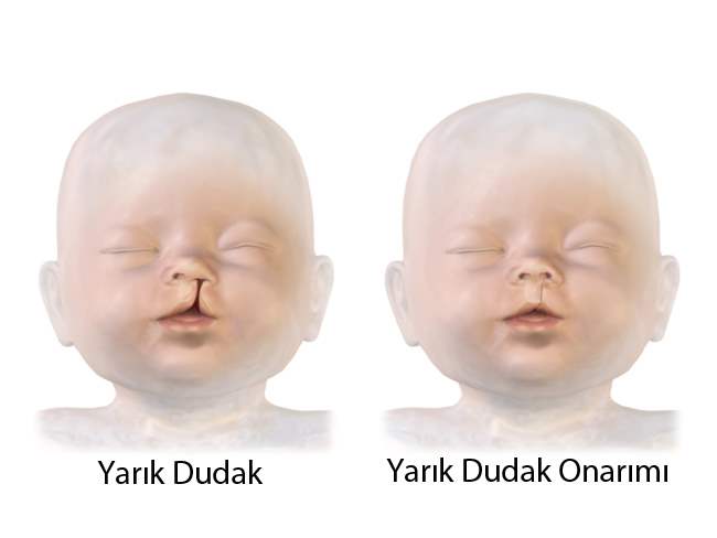 Yarık Dudak, Yarık Damak