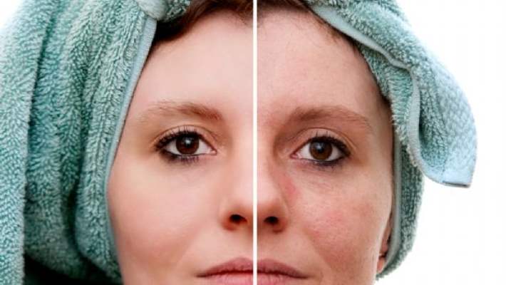 Akne Dünyaya Bakışınızı Değiştirebilir