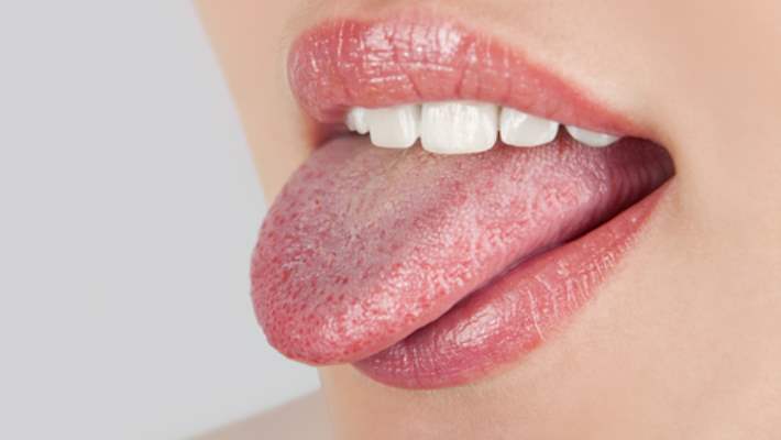 Dilde (Uçuk) Herpes
