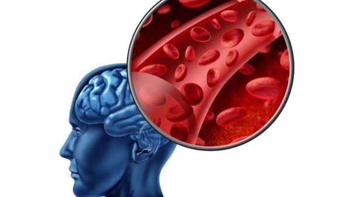 Felç Ve Felç Riskini Arttıran Etmenler