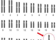 Turner Sendromu Nedir? Turner Sendromu Nedir?
