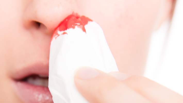 Burun Kanaması Neden Olur?