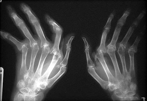 Romatoid Artrit Nedir ve Belirtileri Nelerdir?