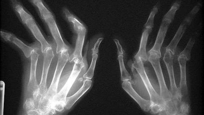 Romatoid Artrit Nedir Ve Belirtileri Nelerdir?