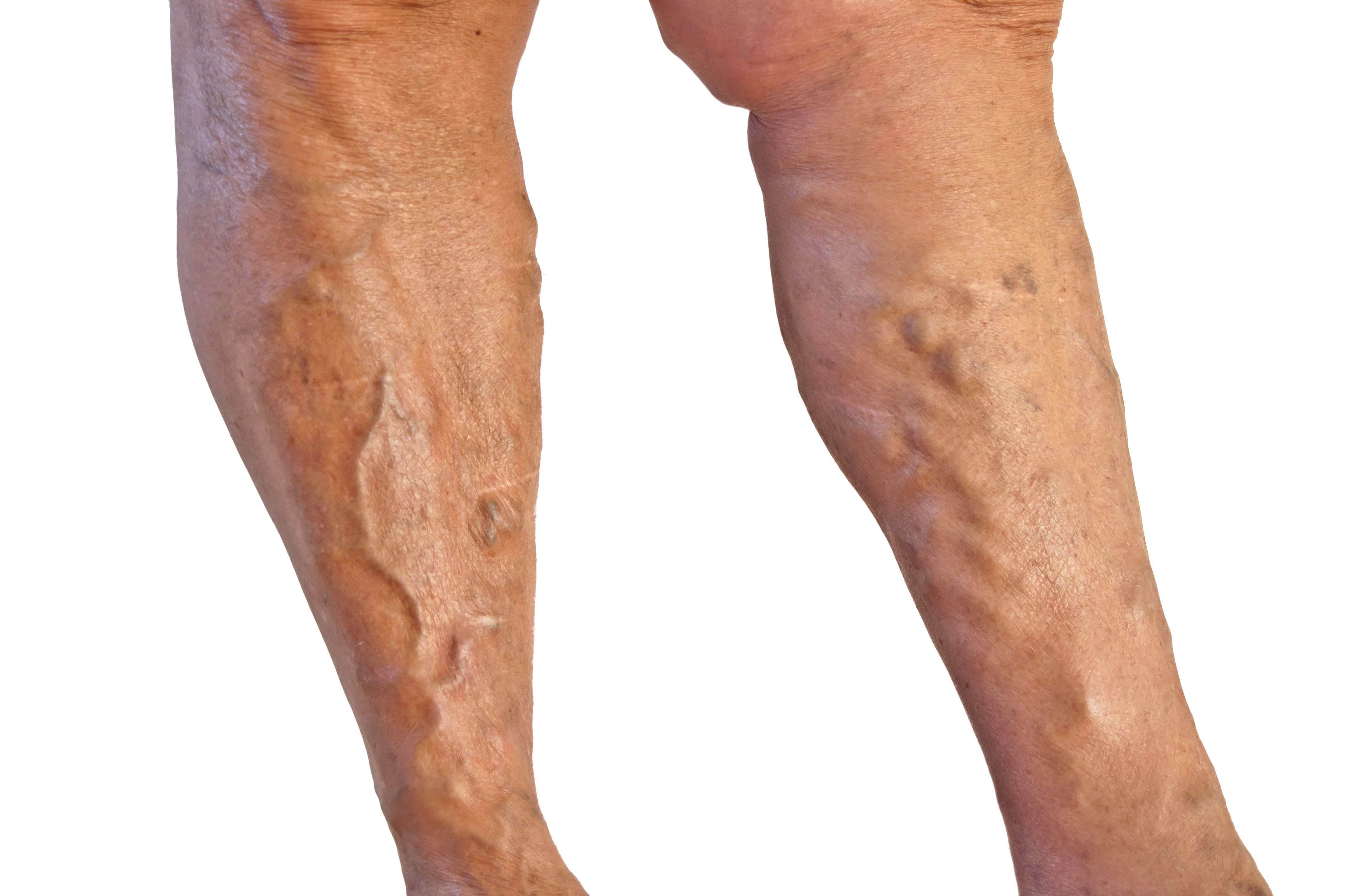 İç Varis Nedir?