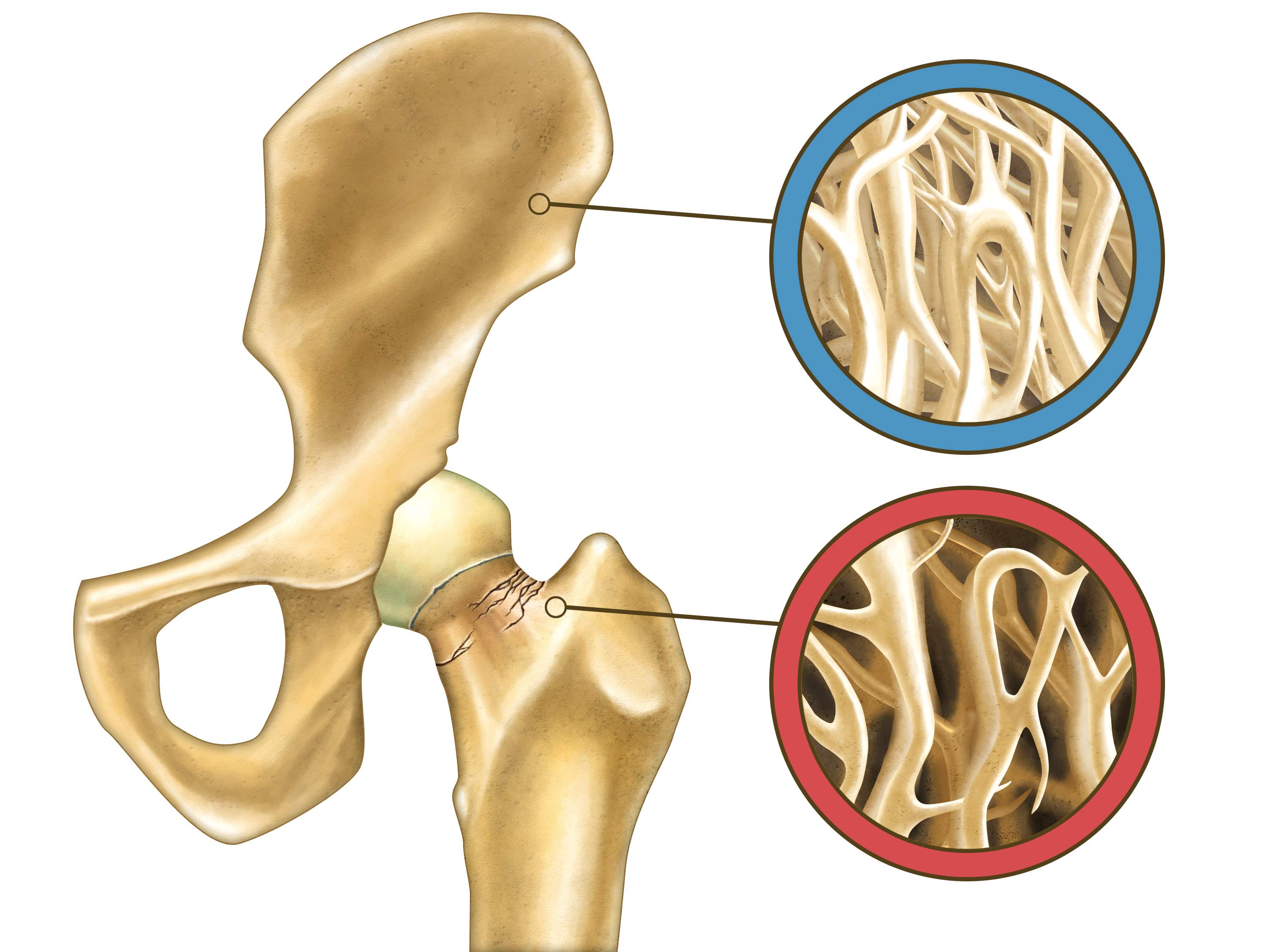 Улучшает кости. Остеопороз кости. Osteoporosis Bone. Остеопороз вымывание кальция.