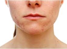 Boyunda ve Çenede Sivilce Görülmesinin Nedenleri Boyunda ve Çenede Sivilce Görülmesinin Nedenleri