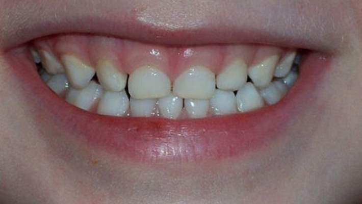 Gun Icinde Cocuklarda Dis Gicirdatmasi Hemen Saglik