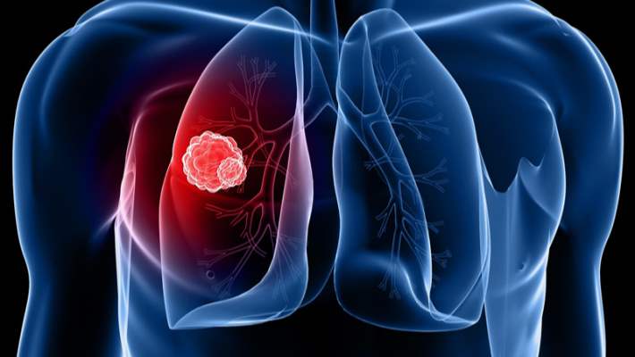 Akciğer Kanserine Karşı Vitaminler