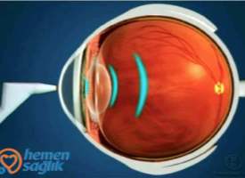 A-Scan Biyometri A-Scan Biyometri