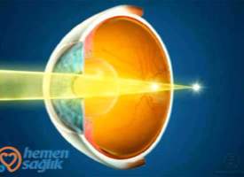 Astigmatizim Nedir Astigmatizim Nedir