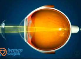 Astigmatizm ve Kontakt Lens Astigmatizm ve Kontakt Lens