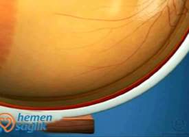 Damar Katman (Koroit) Damar Katman (Koroit)