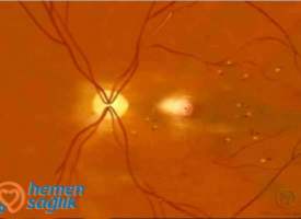 Diyabetik Retinopati Diyabetik Retinopati