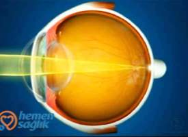 Göz Merceği Göz Merceği