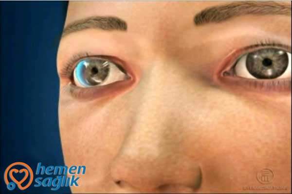 Göze Kaçan Tozların Temizlenmesi (Kontakt Lens)