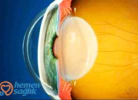 İris Nedir İris Nedir