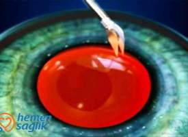 Katarakt Cerrahisi (Fakoemülsifikasyon) Katarakt Cerrahisi (Fakoemülsifikasyon)