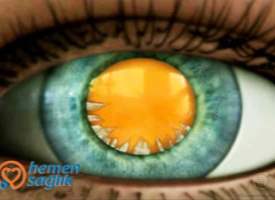 Katarakt Türü/Kortikal Katarakt Katarakt Türü/Kortikal Katarakt