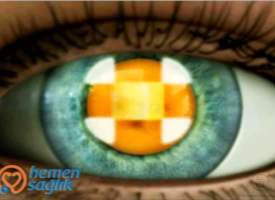 Katarakt Türü/Nükleer Skleroz Katarakt Türü/Nükleer Skleroz