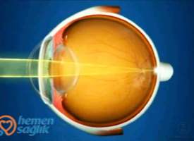 Kornea Nedir Kornea Nedir