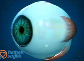 Koroidal Nevüs Koroidal Nevüs