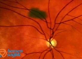 Koroidal Nevüs Tedavi videosu Koroidal Nevüs Tedavi videosu