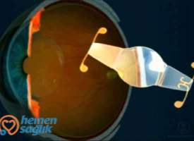 Akomodatif IOL Akomodatif IOL