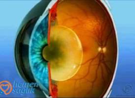 Mikroinsizyon Fakoemulsifikasyon Cerrahisi Mikroinsizyon Fakoemulsifikasyon Cerrahisi