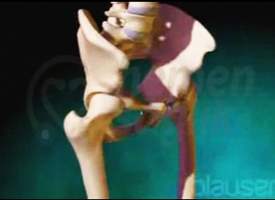 Kalça Osteoartriti