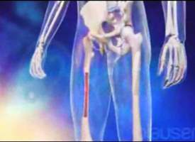 Kronik Lenfositik Lösemi (KLL) Kronik Lenfositik Lösemi (KLL)