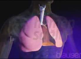 Kronik Obstrüktif Akciğer Hastalığı (KOAH)