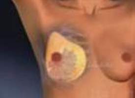 Meme Küçültme Meme Küçültme