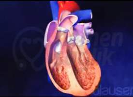 Mitral Kapak Darlığı Tedavisi (Valvüloplasti) Mitral Kapak Darlığı Tedavisi (Valvüloplasti)