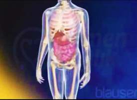 Osteosarkom Osteosarkom