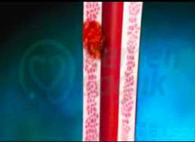 Yemek Borusu Kanseri Yemek Borusu Kanseri